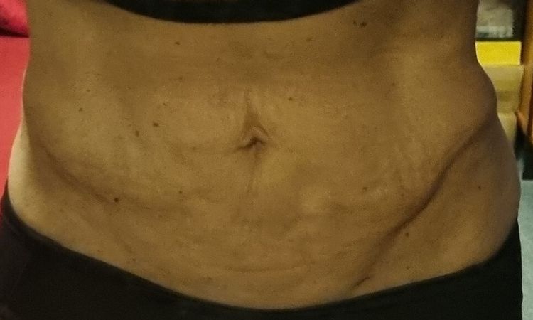 Laserova liposukce bricha - 78903