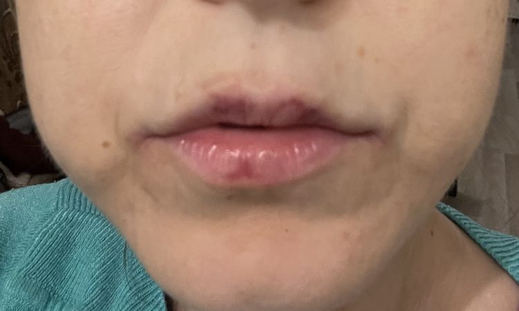 Puchýřek po výplní juvederm - 79023