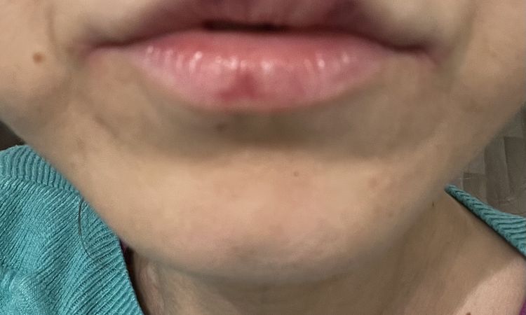 Puchýřek po výplní juvederm - 79024