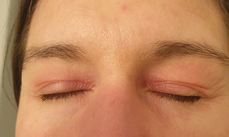 Botolutoxin v případě podrážděného očního okolí (oteklá zarudlá víčka) - 79867