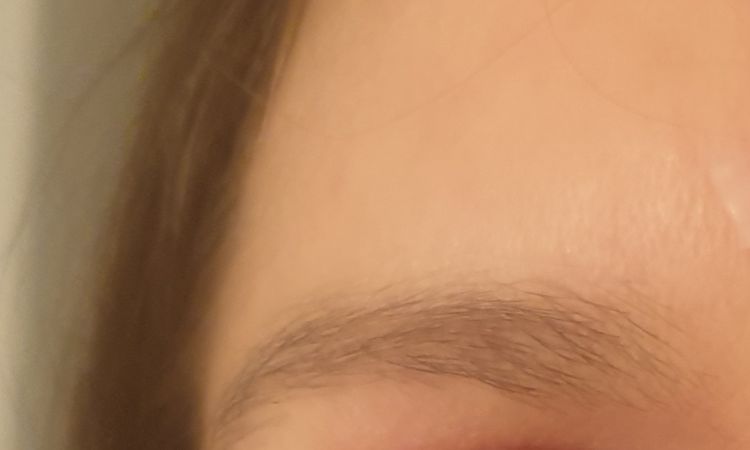 Botolutoxin v případě podrážděného očního okolí (oteklá zarudlá víčka) - 79868