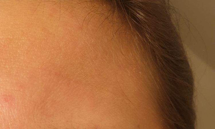 Botolutoxin v případě podrážděného očního okolí (oteklá zarudlá víčka) - 79869