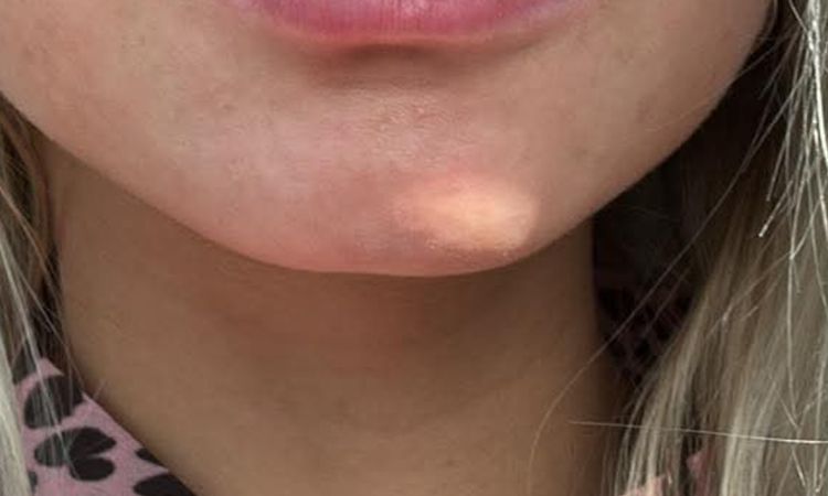 O hodně zvětšené rty než před tím - 79913