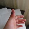 Paricální sutura šlachy extenzoru prstu - opakovaná sutura po zahojení?