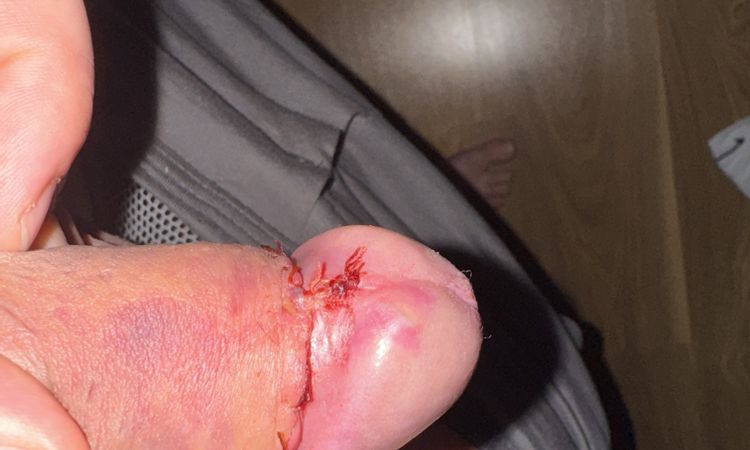 Jsem dva dny po úplné obřízce a ze zadu na žaludu se mi udělala boulička - 81142