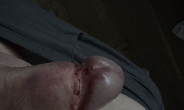 Jsem dva dny po úplné obřízce a ze zadu na žaludu se mi udělala boulička - 81143