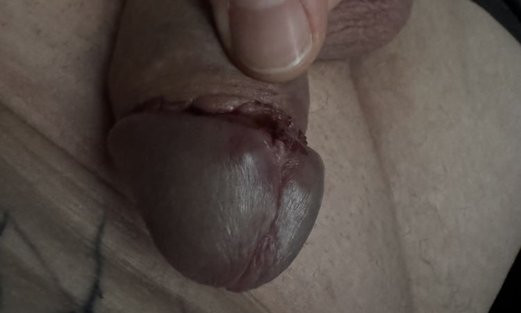 Jsem dva dny po úplné obřízce a ze zadu na žaludu se mi udělala boulička - 81144
