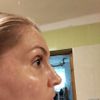 Odstranění pigmentací, melasma?