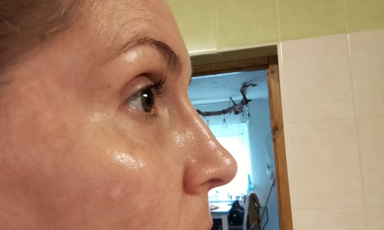 Odstranění pigmentací, melasma? - 82000