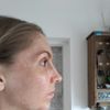 Odstranění pigmentací, melasma?