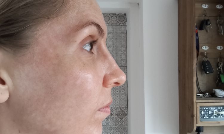 Odstranění pigmentací, melasma? - 82001