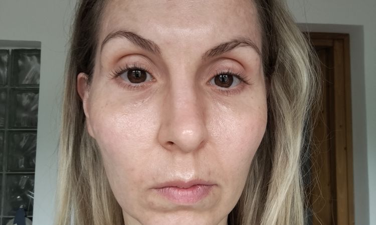 Odstranění pigmentací, melasma? - 82002