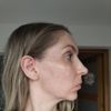 Odstranění pigmentací, melasma?