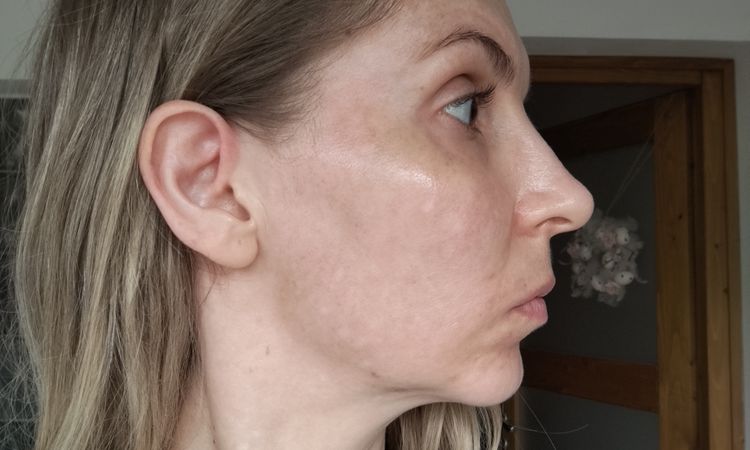 Odstranění pigmentací, melasma? - 82003