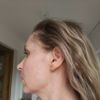 Odstranění pigmentací, melasma?