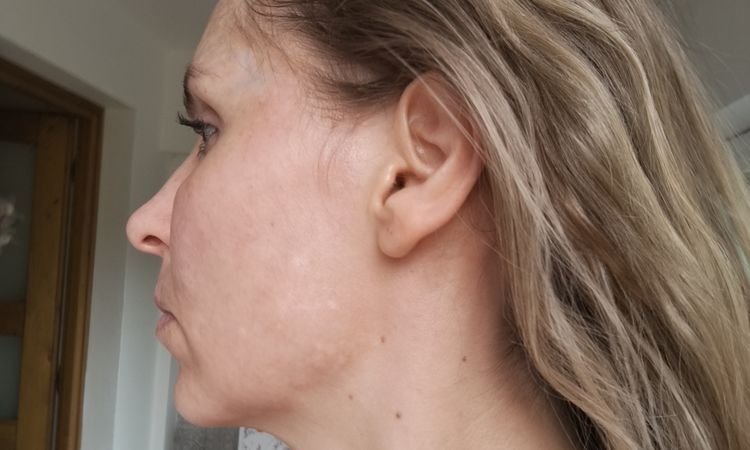 Odstranění pigmentací, melasma? - 82004