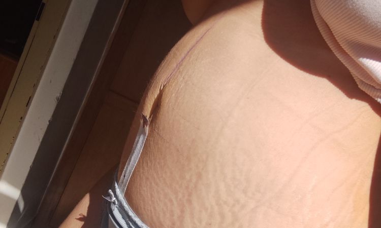 Abdominoplastika se sešitím břišních svalů + pupeční kýla - 82005