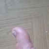 Hypertrofická nebo keloidni jizva