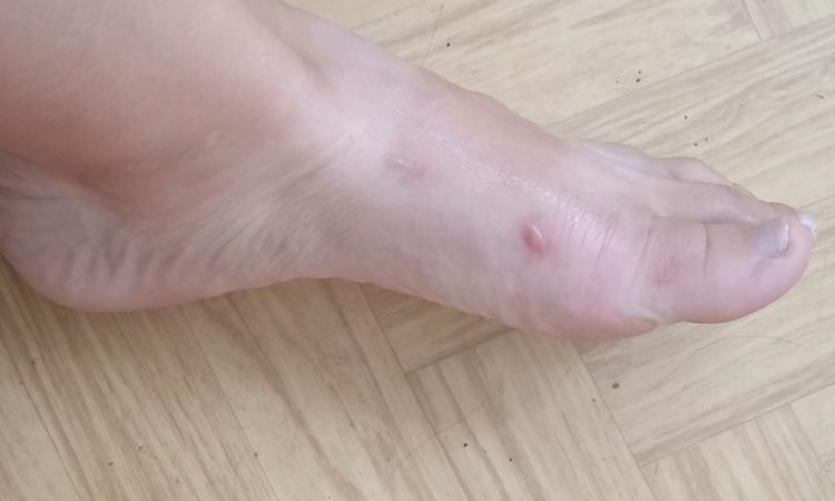 Hypertrofická nebo keloidni jizva - 82231