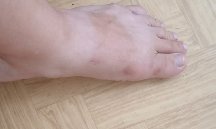 Hypertrofická nebo keloidni jizva - 82232