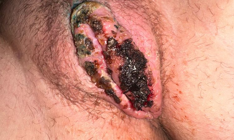 LABIOPLASTIKA - otok, rozestouplé stehy, tvrdé krusty po Novikovu - 82433