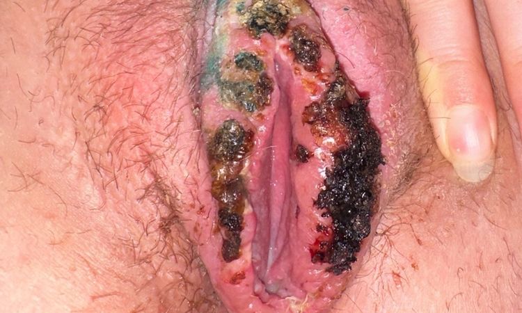 LABIOPLASTIKA - otok, rozestouplé stehy, tvrdé krusty po Novikovu - 82434