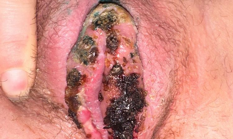 LABIOPLASTIKA - otok, rozestouplé stehy, tvrdé krusty po Novikovu - 82435