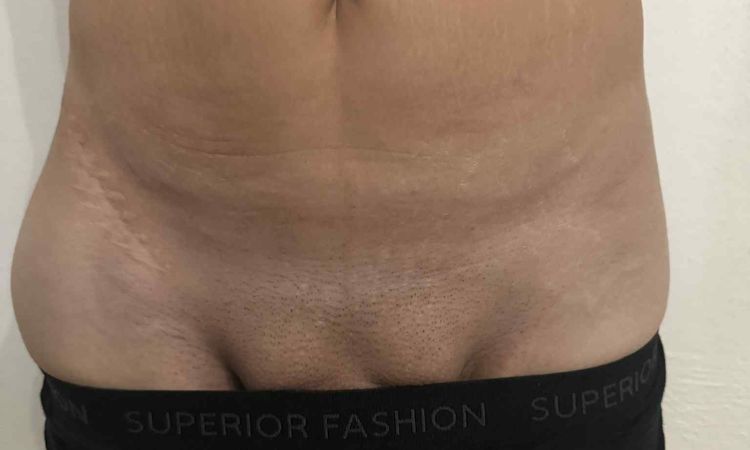 Miniabdominoplastika nebo klasická abdominoplastika po velkém zhubnutí? - 82677