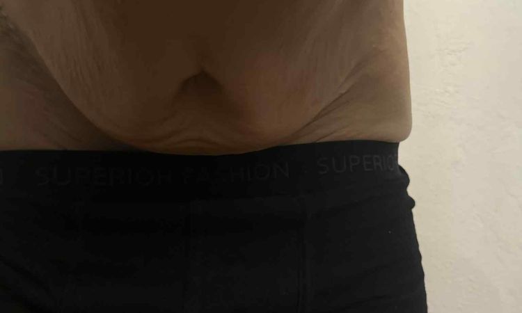 Miniabdominoplastika nebo klasická abdominoplastika po velkém zhubnutí? - 82678
