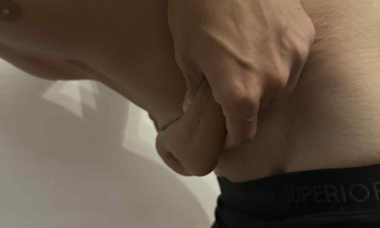 Miniabdominoplastika nebo klasická abdominoplastika po velkém zhubnutí? - 82679
