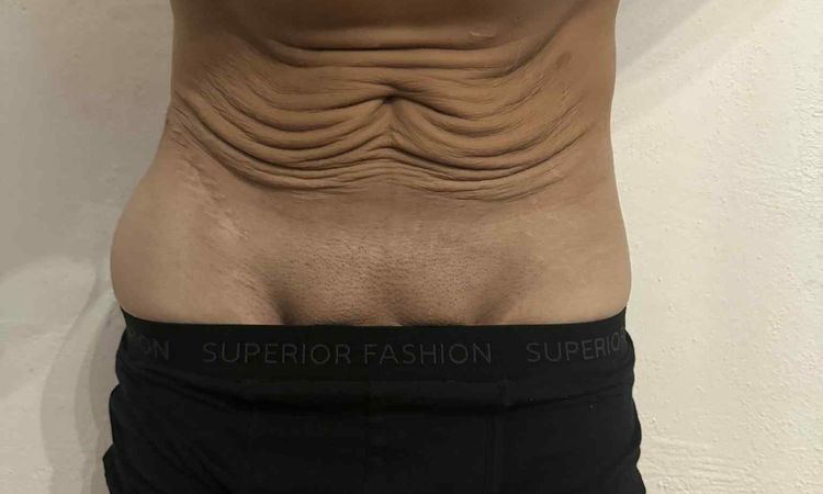 Miniabdominoplastika nebo klasická abdominoplastika po velkém zhubnutí? - 82680