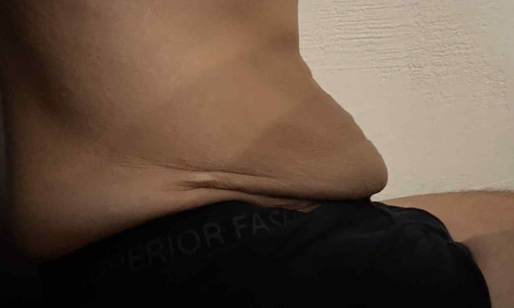 Miniabdominoplastika nebo klasická abdominoplastika po velkém zhubnutí? - 82681