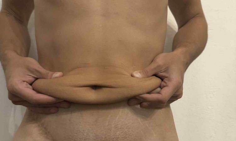 Miniabdominoplastika nebo klasická abdominoplastika po velkém zhubnutí? - 82682