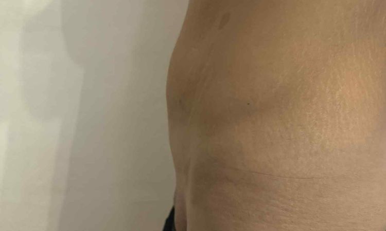Miniabdominoplastika nebo klasická abdominoplastika po velkém zhubnutí? - 82683