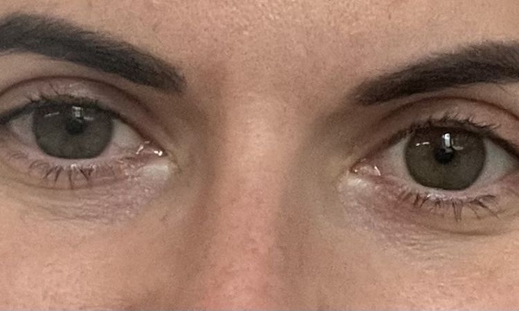 Posouzení nedovření oční štěrbiny - 82775