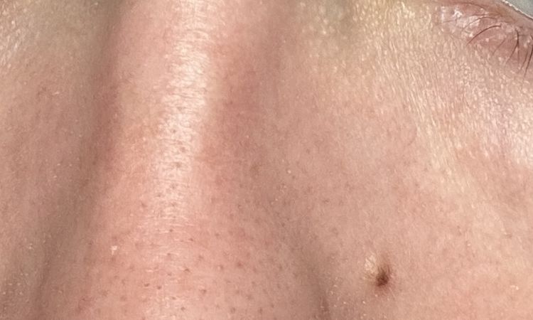 Modré žíly pod očima - 82805