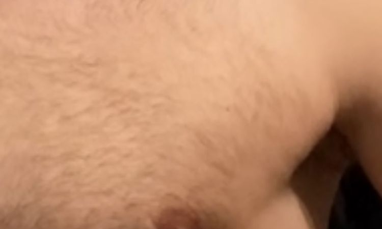 Gynekomastie propadlina po operaci - 83025