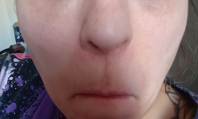 Kyselina hyaluronova - 83048