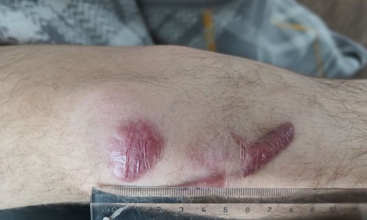 Korekce jizev na koleně. - 83592