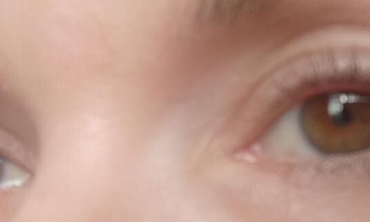 bulka u jizvy a možnosti vyplnění jizvy - 83688