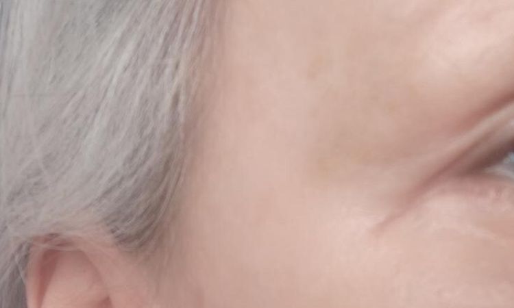 bulka u jizvy a možnosti vyplnění jizvy - 83689