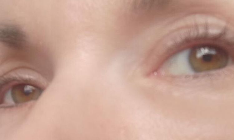 bulka u jizvy a možnosti vyplnění jizvy - 83690