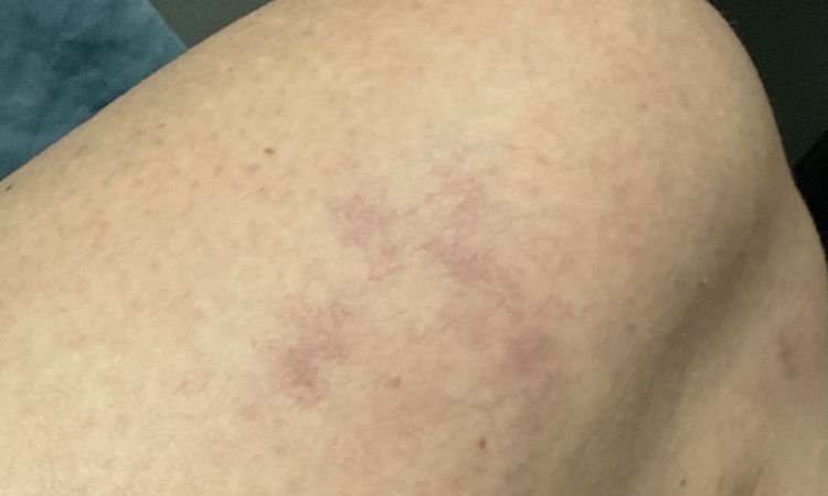 řešení na matting / metličky (drobné žilky/žilečky) - 83827