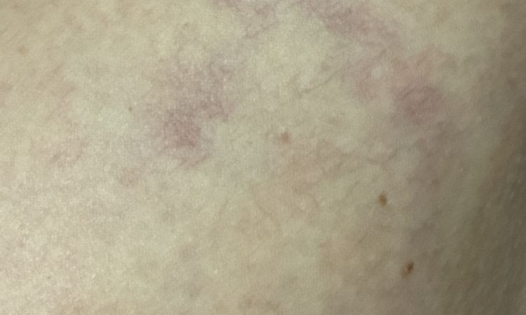 řešení na matting / metličky (drobné žilky/žilečky) - 83828