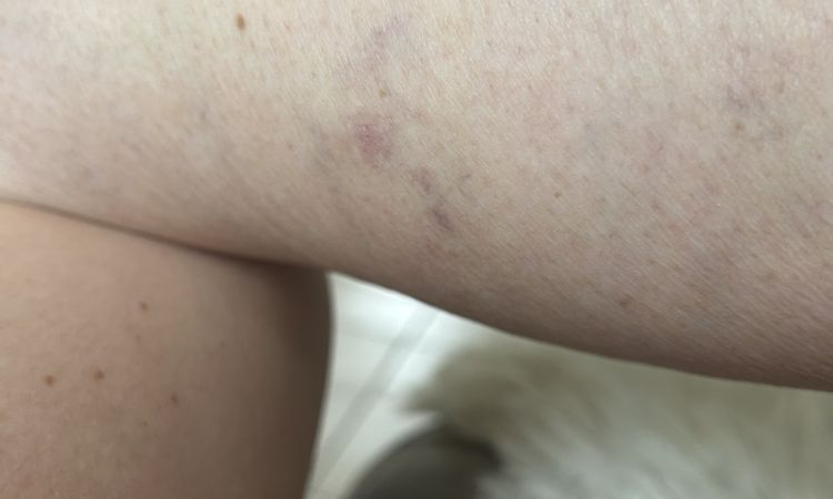 žilní sneti, které nemizí - 84041