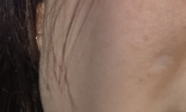 Jizva po odstranění znaménka laserem - 84064