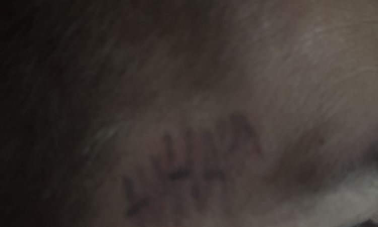 Je možné chirurgicky odstranit tetování ze spánku o velikosti cca 2x3 cm ? - 84201