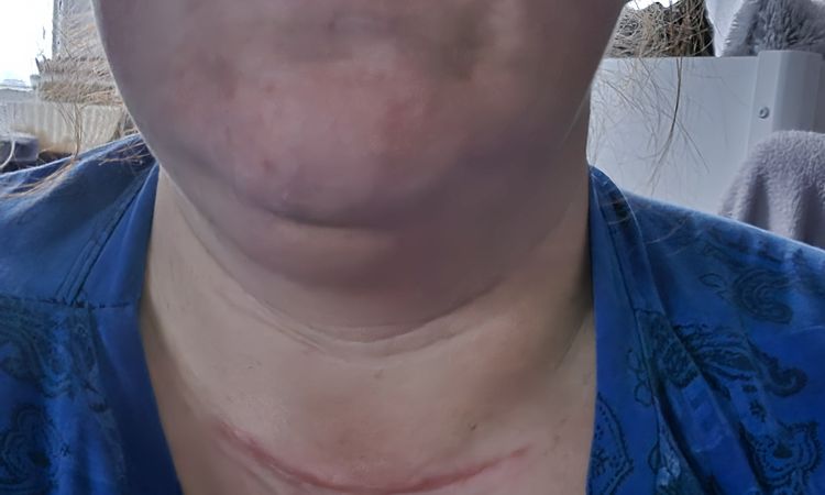 Odstraneni stitne zlazy - 84350