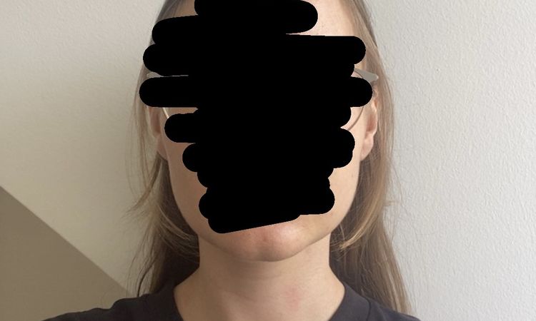 Má pro mě smysl lipolýza podbradku, nebo je nutno problém řešit jinak? - 84471