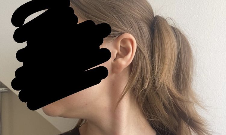 Má pro mě smysl lipolýza podbradku, nebo je nutno problém řešit jinak? - 84472